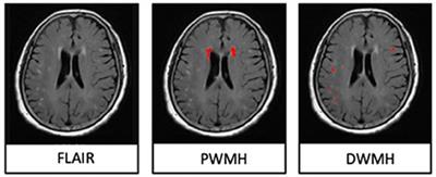 Different mechanisms in periventricular and deep white matter hyperintensities in old subjects